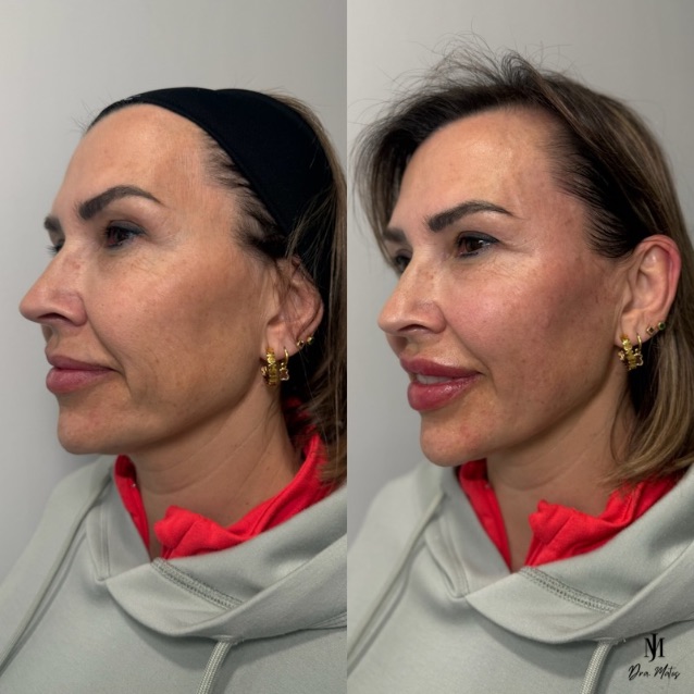 Reposición de Pómulos