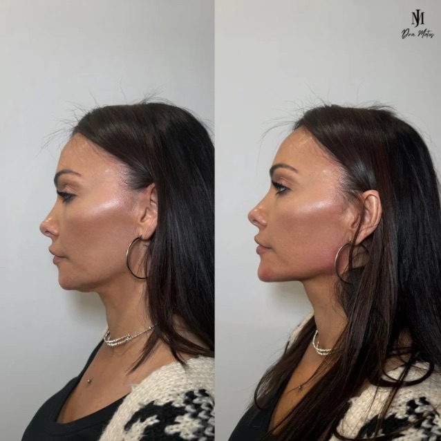 Definición de Mentón